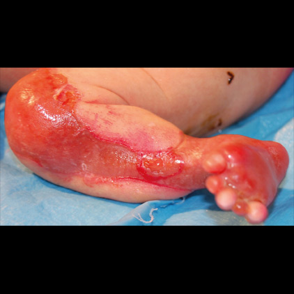 Aplasia cutis congenita dell'arto inferiore e piede in neonata con epidermolisi bollosa distrofica recessiva